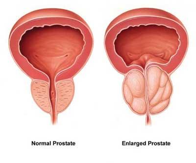 Enlarged Prostate (BPH)